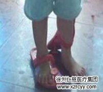 男子因穿拖鞋致骨折 專家提醒 拖鞋也要正確穿