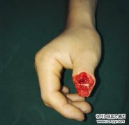 男子大拇指被電擊掉 徐州仁慈醫院“移花接木”用腳趾修復