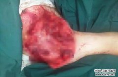 27歲小伙車禍險截肢 徐州仁慈醫院斷肢再植完“臂”歸趙
