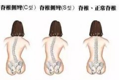 徐州市兒童醫(yī)院：孩子雙肩不對稱?可能得了這種病……