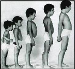 5歲男孩走路老摔跤，原來是患有肌營養不良癥