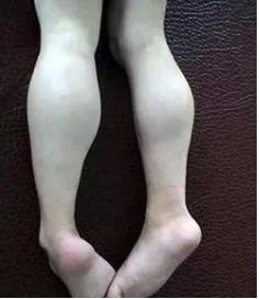 5歲男孩走路老摔跤，原來是患有肌營養不良癥