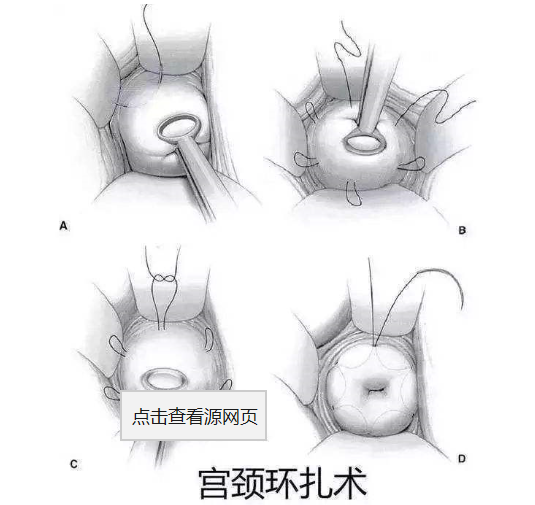 曾因宮頸機能不全妊娠終止，現二胎喜懷雙胞胎