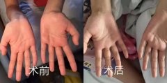 愛出手汗也是病？徐州市腫瘤醫院侯予龍博士微創手術30分鐘搞定！