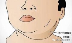 腮部腫痛 疑似腮腺炎，具有傳染性嗎？