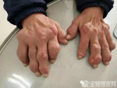 戳中“痛”點(diǎn) 這些都要懂！徐州內(nèi)分泌科專家徐春榮講解痛風(fēng)那些事