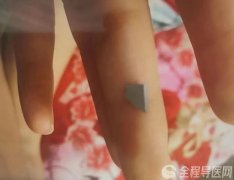 與父母爭吵 16歲少女沖動吞食刀片 徐礦總醫院消化內鏡中心驚險施救